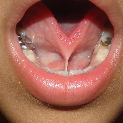 [Ankyloglossia_2_SQ.jpg]