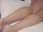 laser hair removal burns