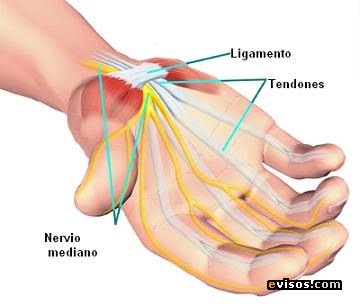 Cuida tu mano del Síndrome De Túnel Carpiano Bilateral Cuida tu mano del Síndrome De Túnel Carpiano Bilateral