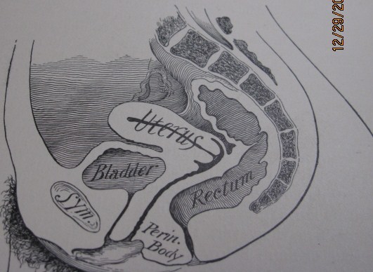 Paragard Diagram