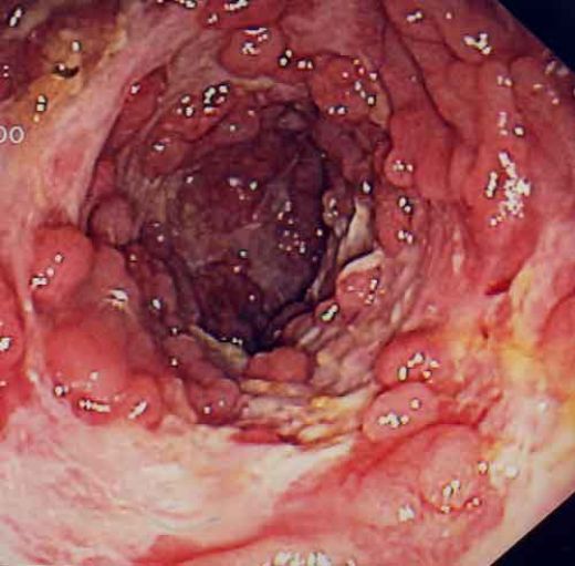 Crohn’s Disease Pictures