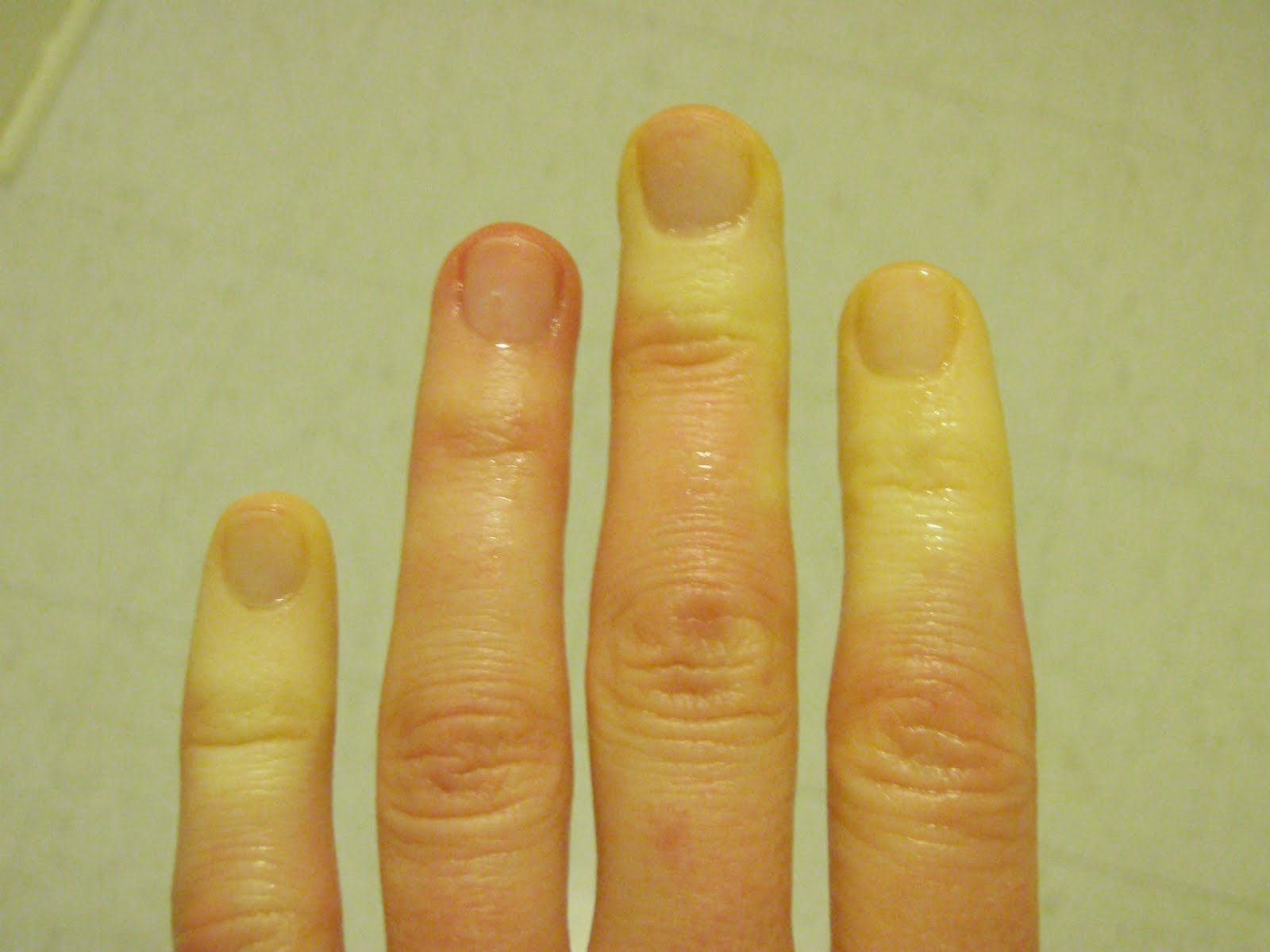 Raynaud's Disease Pictures
