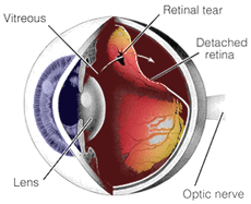 eye detached retina symptoms eye detached retina symptoms