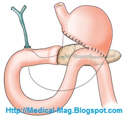 Pancreatic Cancer Symptoms