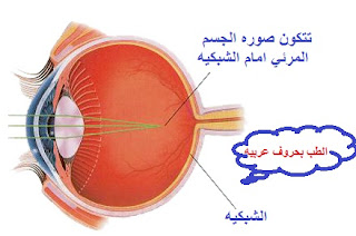 الجلوكوما Glaucoma تقنيات العلاج المختلفه %25D9%2582%25D8%25B5%25D8%25B1+%25D8%25A7%25D9%2584%25D9%2586%25D8%25B8%25D8%25B1+myopia