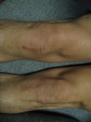 After Acl Surgery