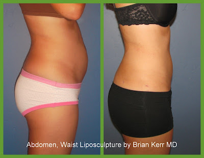 Liposuction Before And After. Look at work in new york, ny jan Because