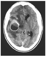 abscess brain ct cerebral sinusitis pathology intracranial complications brandy infection understood orbital