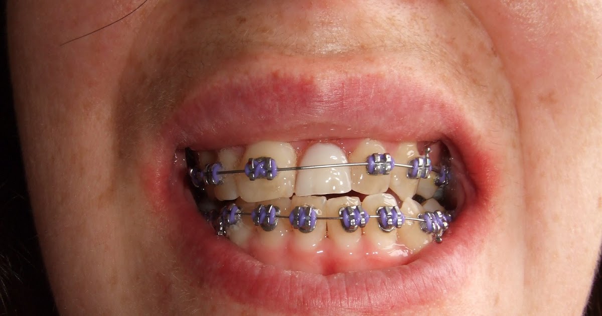 Fay's Braces and BSSO Jaw Surgery Journey First Adjustment