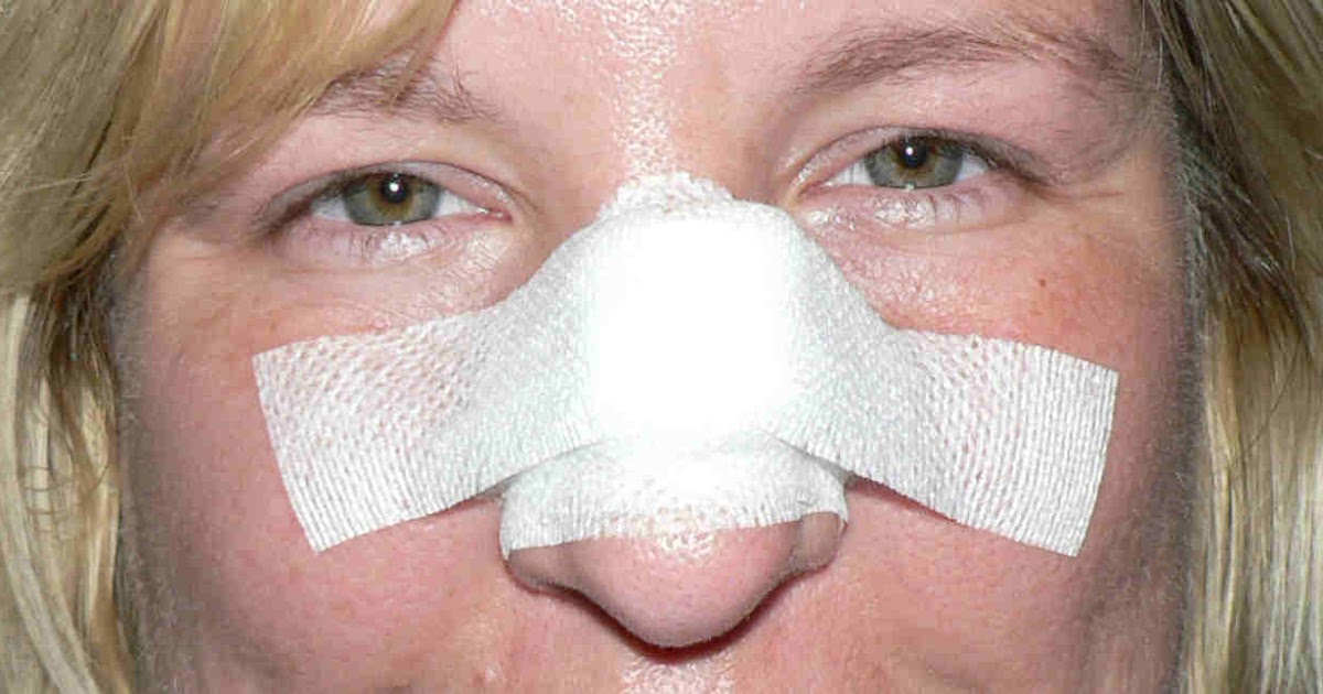 Post Mohs Surgery on the Bridge of My Nose The First 3 Days