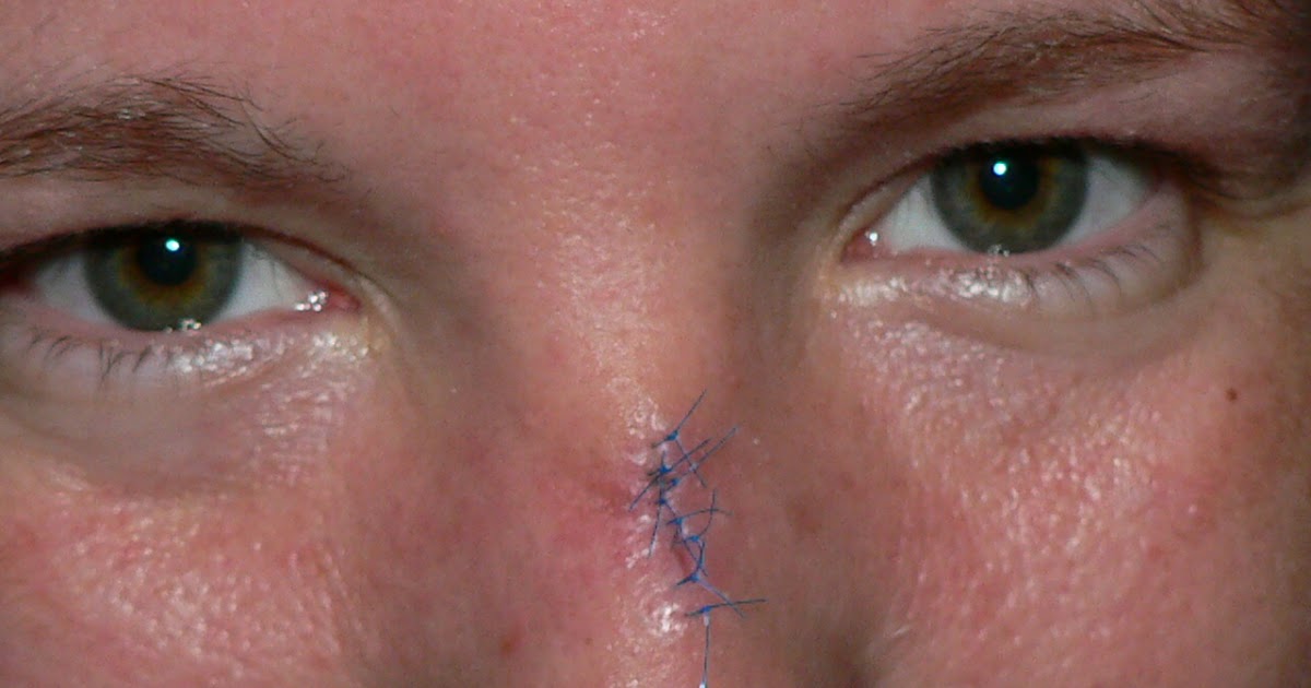 Post Mohs Surgery on the Bridge of My Nose PostMohsNoseor 1 Week later