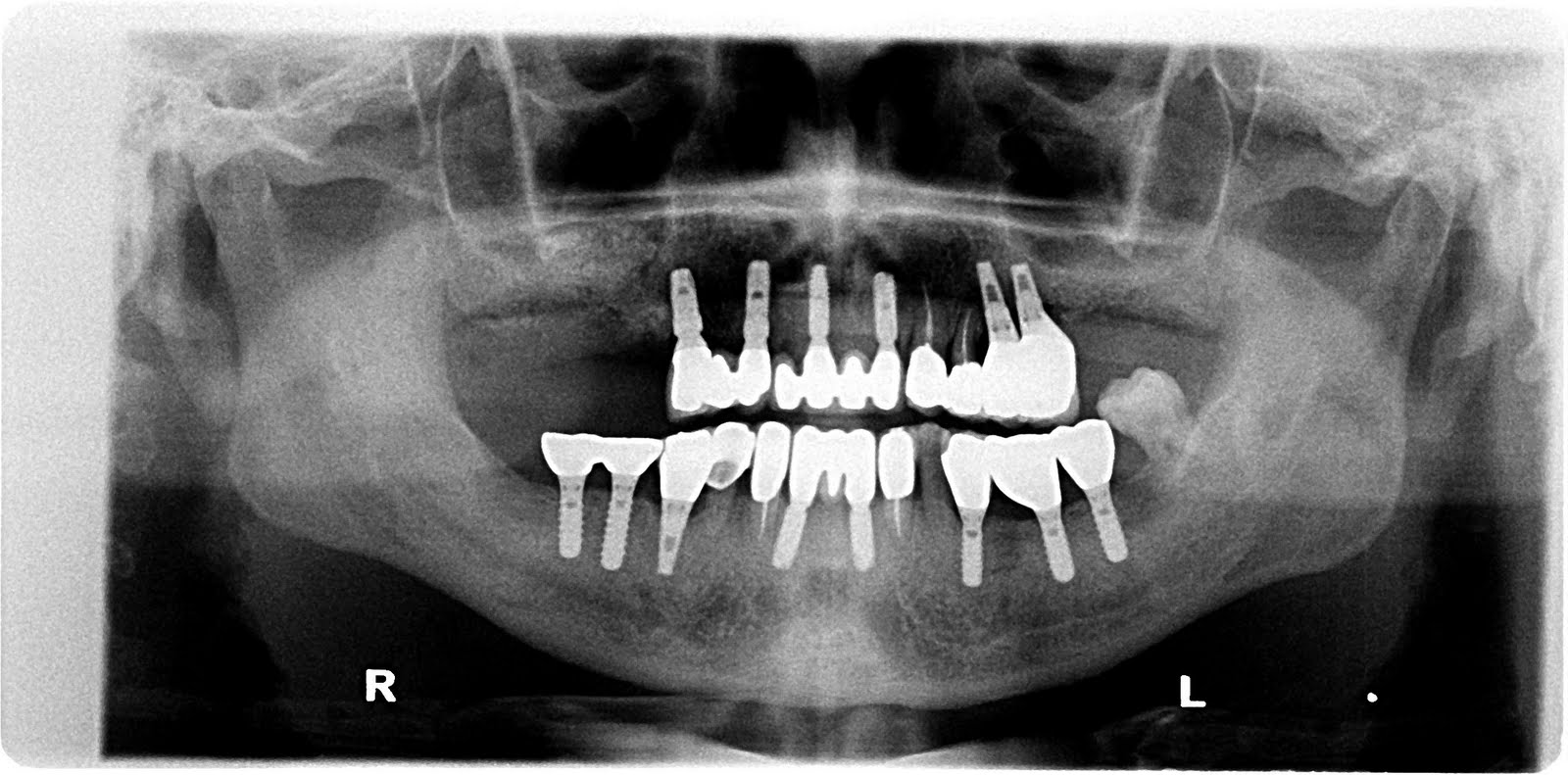 Dental implant professional Sinus membrane perforation Management