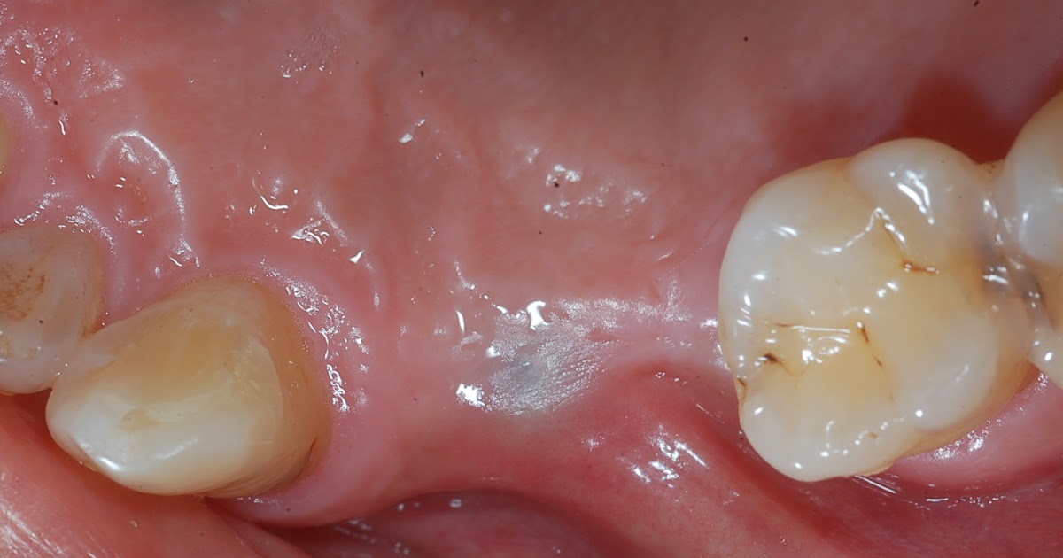 Dental implant professional 2nd surgery for implants exposure via