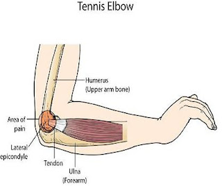 Right Arm Hurts Near Elbow : Stop Tennis Elbow Pain! Get The Ultimate Golf Elbow Treatment Using 5 Easy Steps!