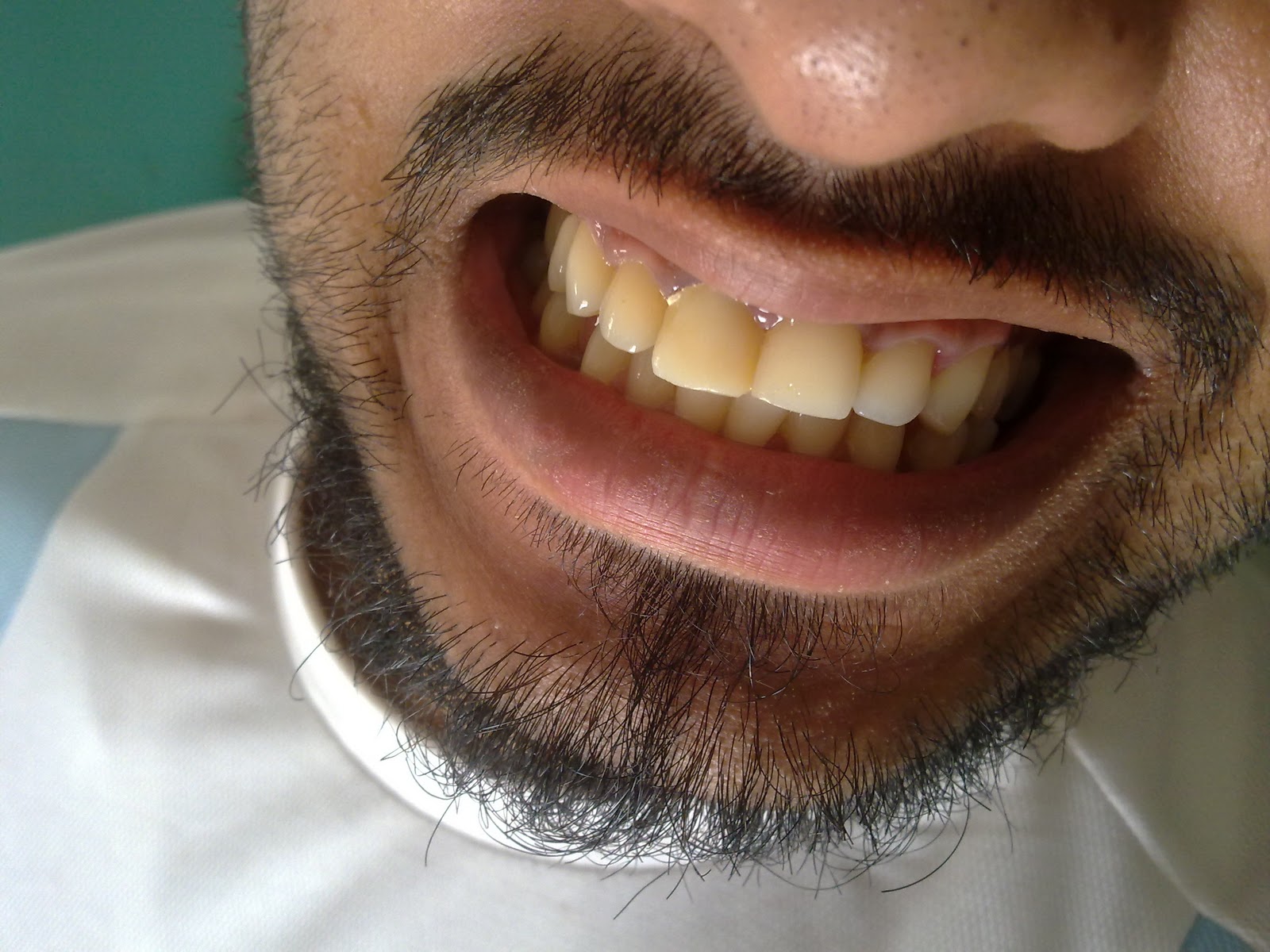 DENTO CARE DENTAL CLINICS 3M LAVA CROWNANTERIOR RESTORATION