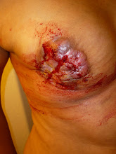 Tumor breaks through