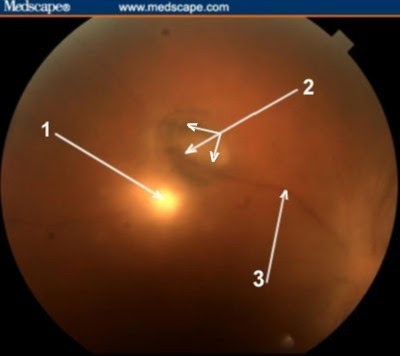 overview of ocular histoplasmosis syndrome ohs Overview – ocular histoplasmosis syndrome histoplasmosis is caused by a fungus commonly found in the dust and soil of the mississippi-ohio river valley region. overview of ocular histoplasmosis syndrome ohs Overview – ocular histoplasmosis syndrome histoplasmosis is caused by a fungus commonly found in the dust and soil of the mississippi-ohio river valley region.