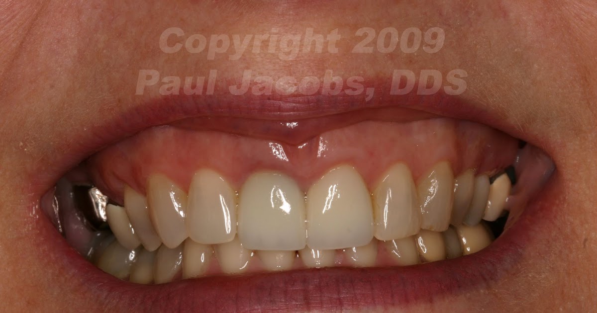 Dental Nation Lip Repositioning