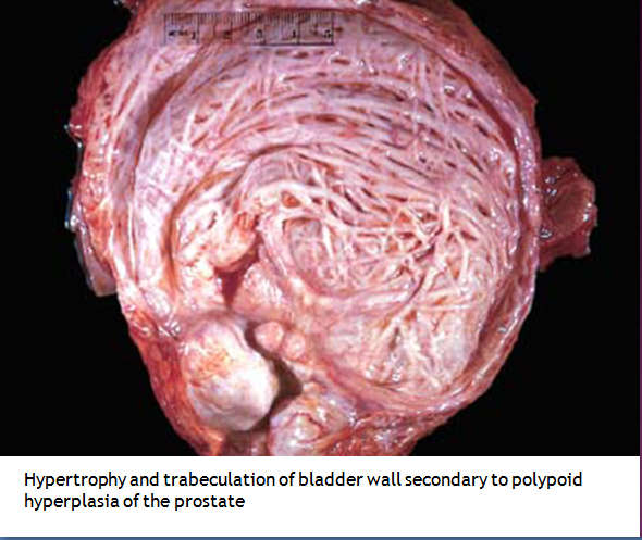 Invasive+high+grade+papillary+urothelial+carcinoma