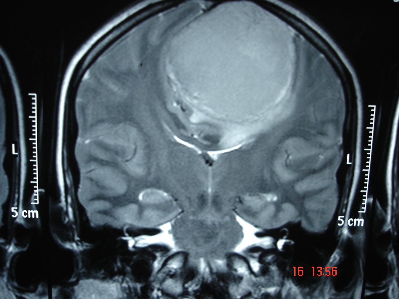 Ct+scan+images+of+brain+tumor
