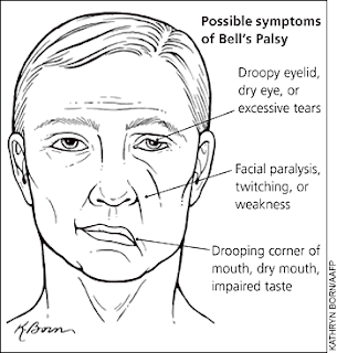 Pathology Blog: Cranial nerves " Bells Palsy"