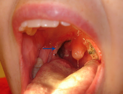 Holes In Throat 12