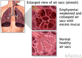 bulbus emphysema
