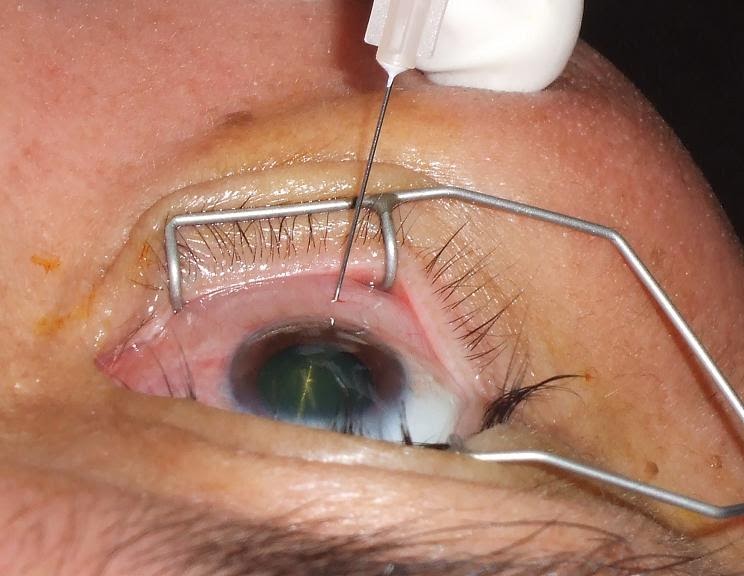 Marianas Eye Needle in the Eye