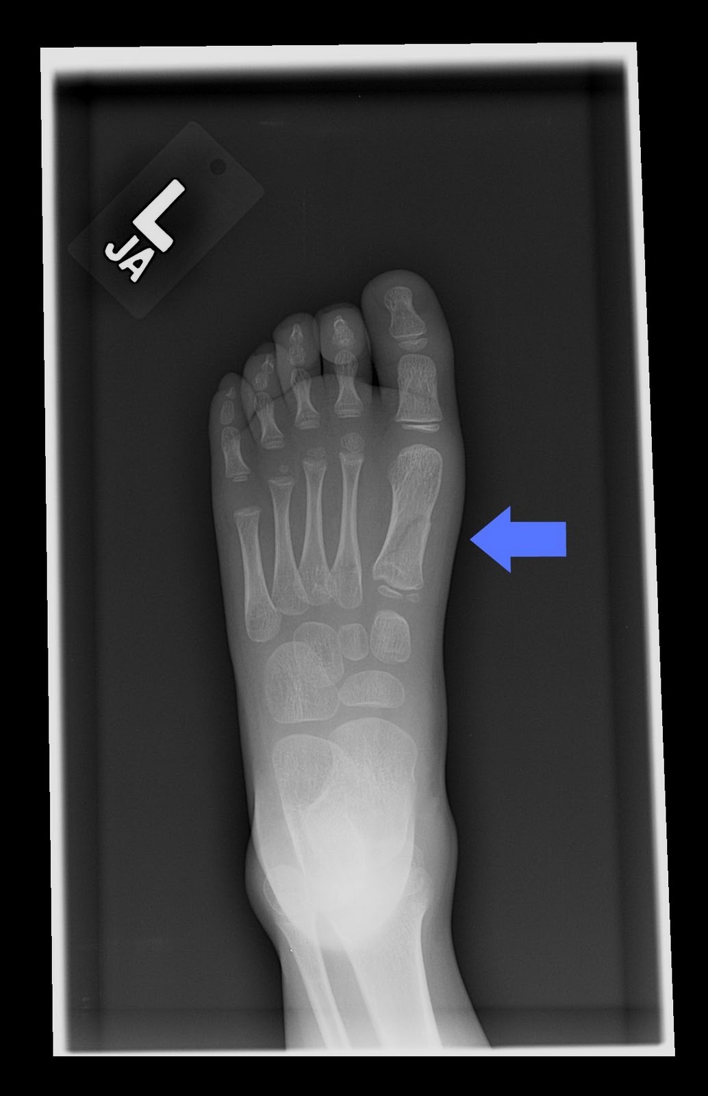 baby foot xray