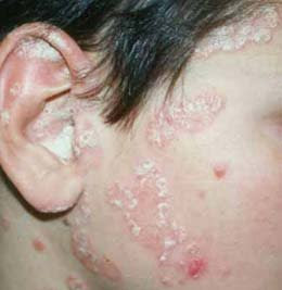 La psoriasis los síntomas los indicios