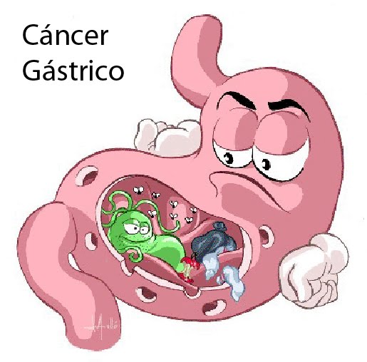 CANCER GASTRICO GASTRECTOMIA cancer gastrico gastrectomia: