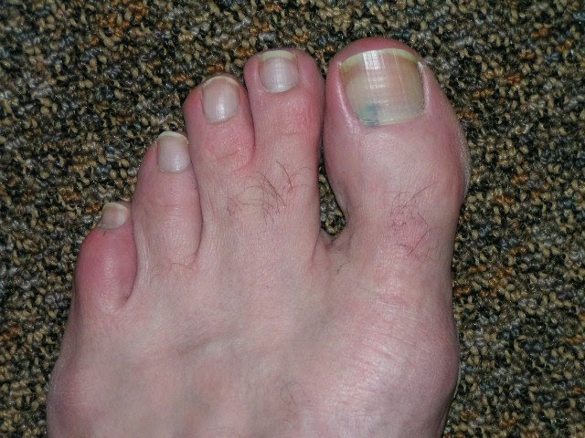 On dot small toenail black Black Spot