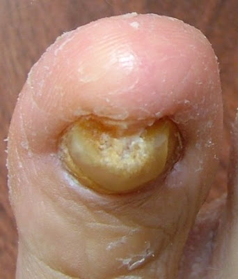 Under Toenail