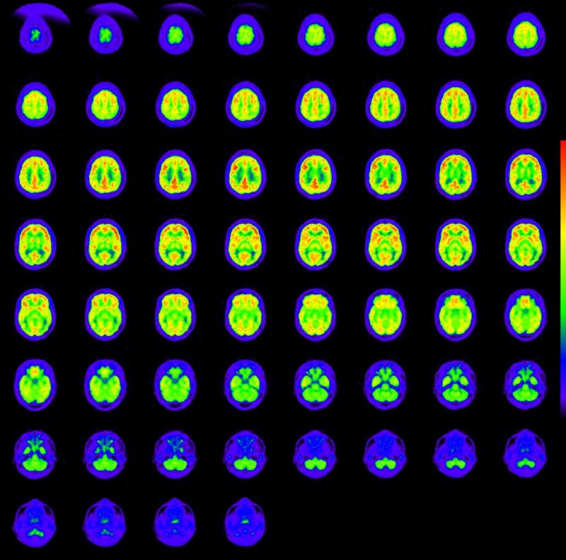 [Sample_PET_brain1.93202725_std.JPG]