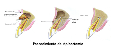 apicectomia ¿Qué es una apicectomía?