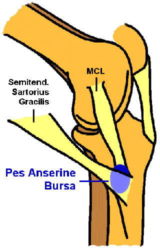 Unusualtrekker Pes Anserinus Bursitis