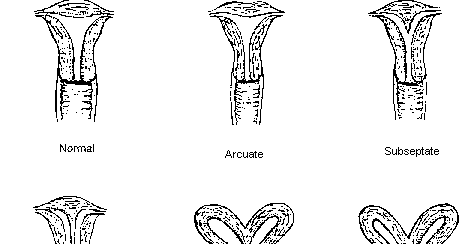Bernardeena: The difference between a uterus bicornis bicollis and a