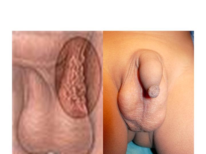 farrah fawcett nude fake boy s testicles swollen