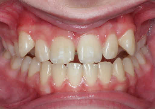 Pictures Of Teeth Before And Gap Teeth Before And After. Pictures Of Teeth Before And