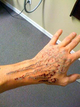 Scar Tattoo Process Tattoo removal process is