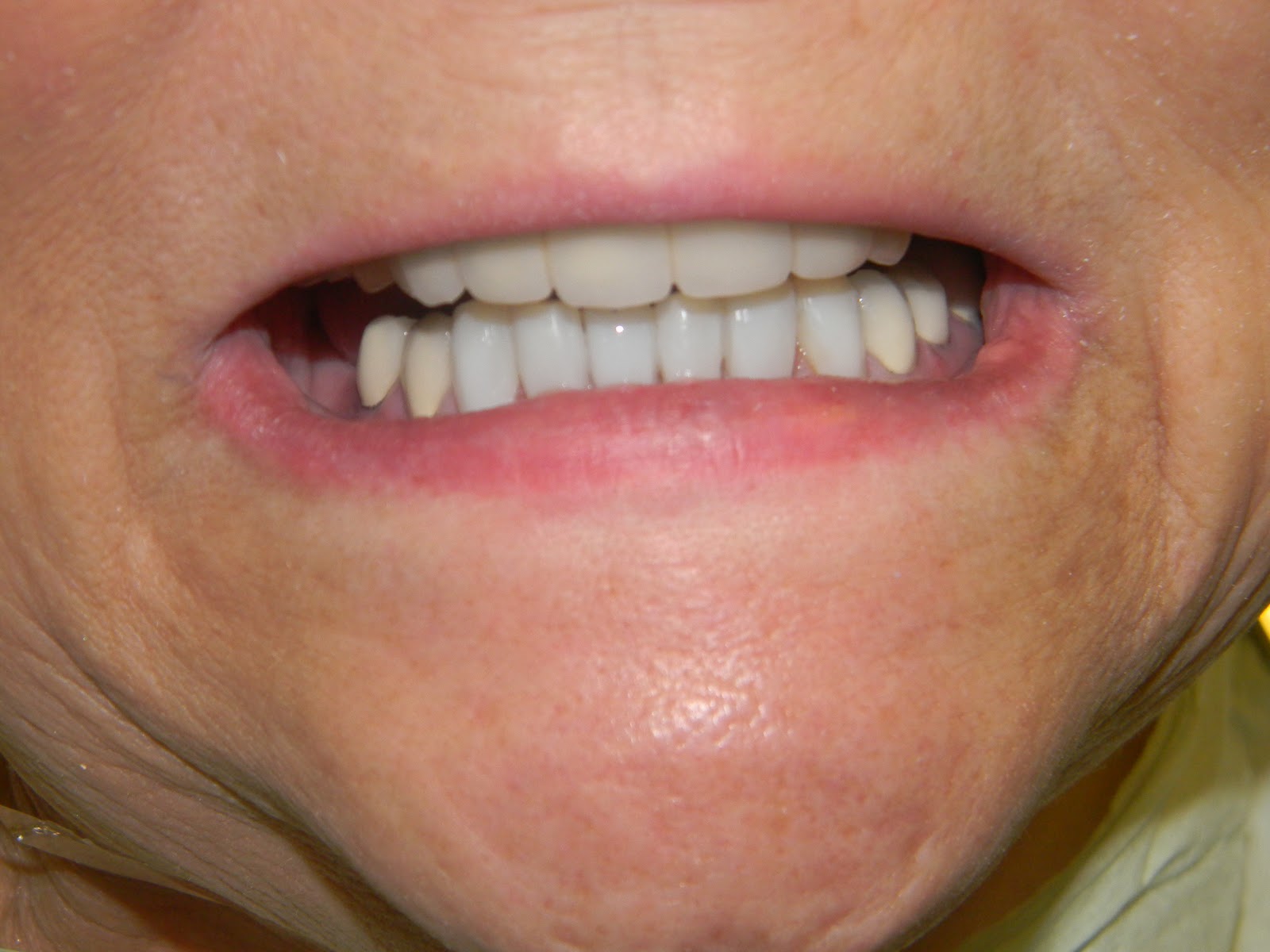 Dental Pearls Cosmetic Dentistry Teeth Bonding