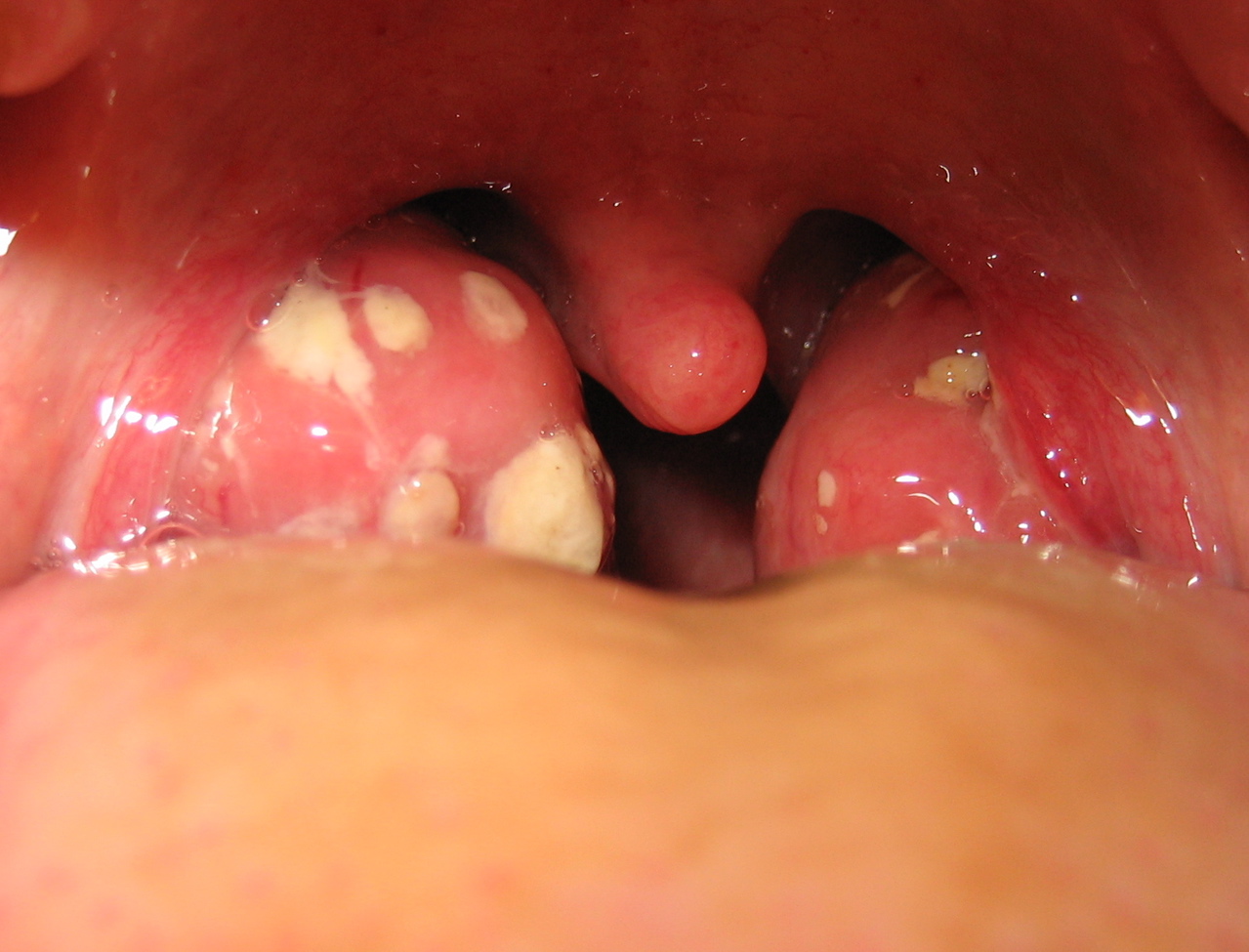 Anatomy Of Tonsils