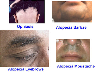 alopecia barbae