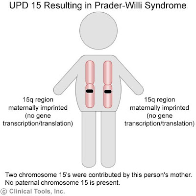 Prader willi syndrome essay 07 picture