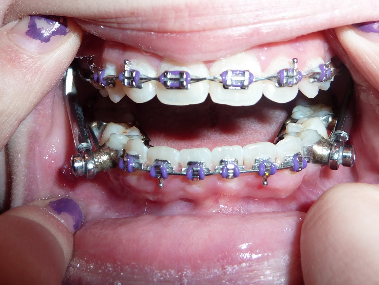 The Clark Family Jenny's Next Phase of Braces