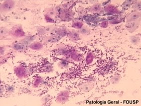 Que medicina tomar de um fungo de pregos