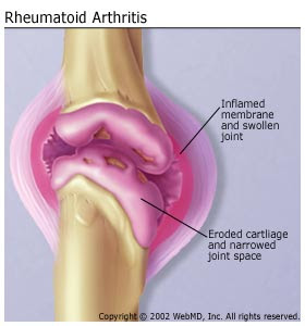 rheumatoid_arthritis.jpg