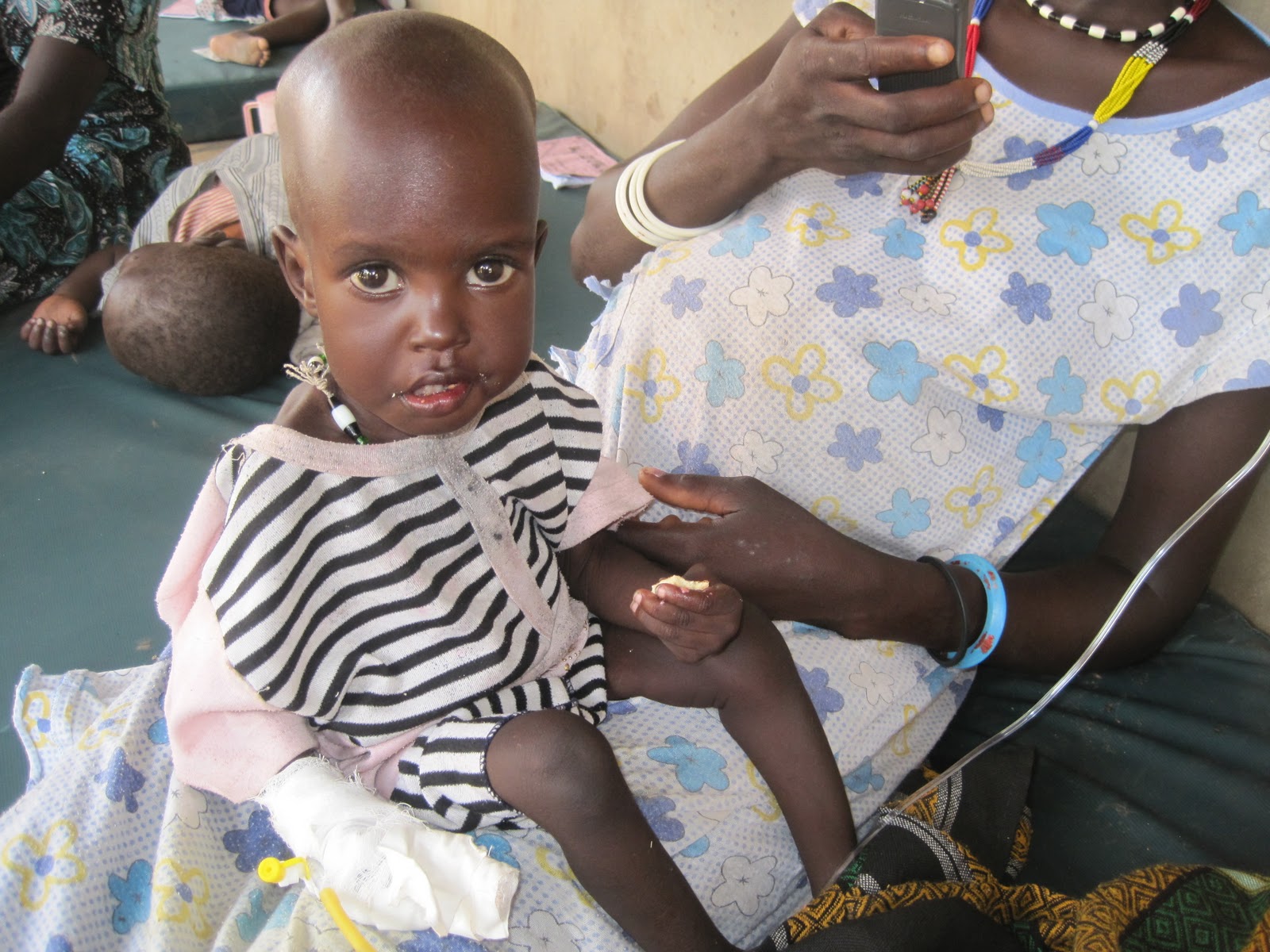 Children With Marasmus