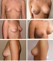 Breast Augmentation