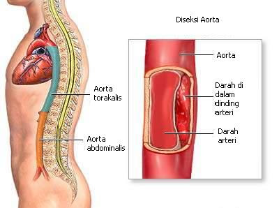 Diseksi Aorta